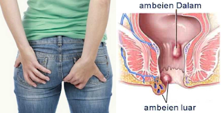 Harga Obat Wasir Alami